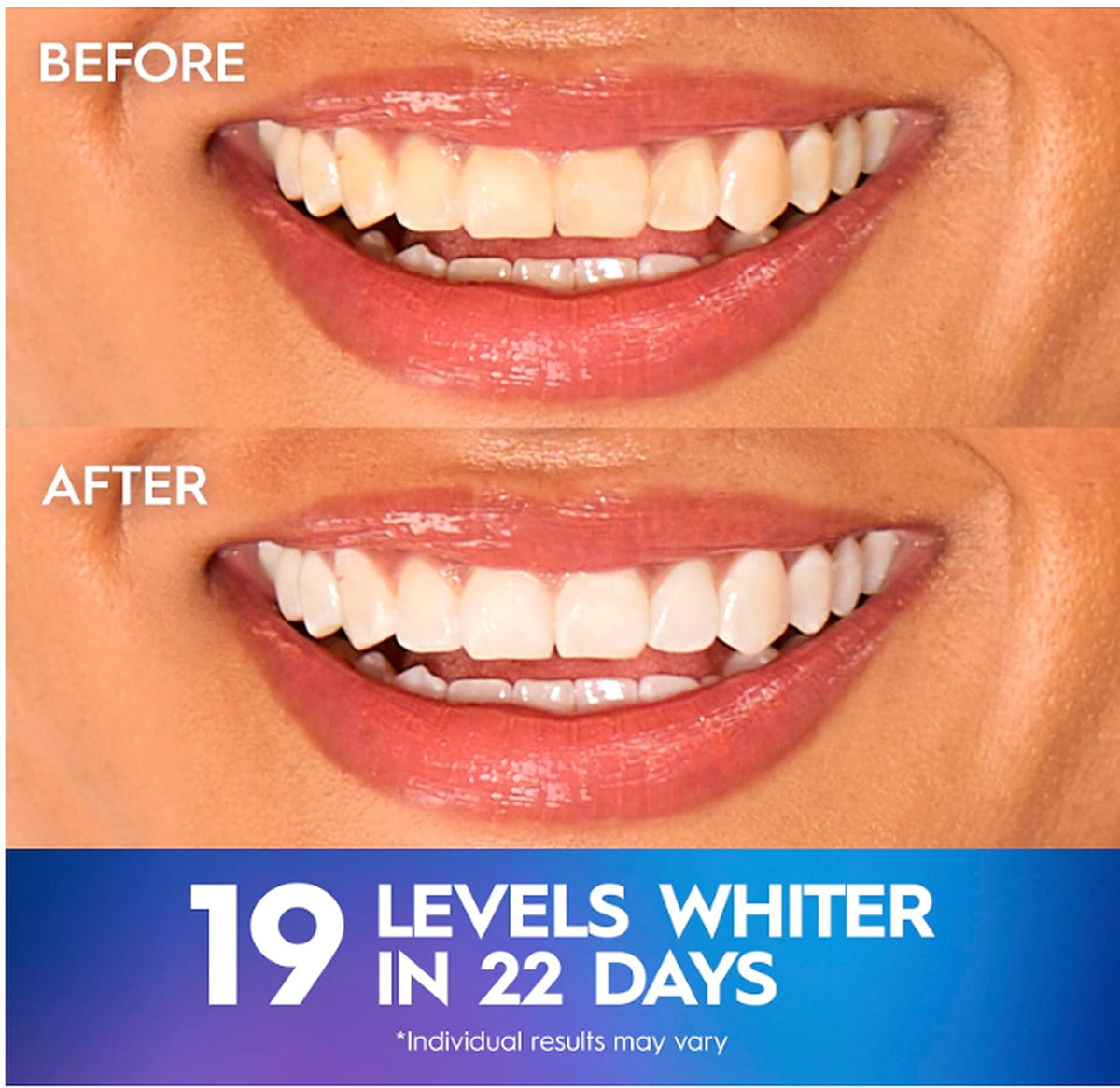 Crest 3D Whitestrips Professional Effects before and after whitening result graphic